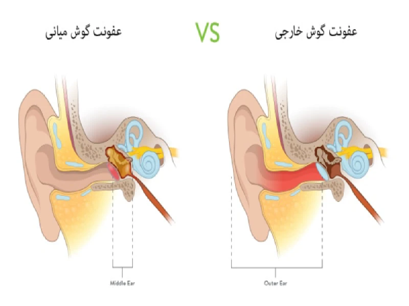 علائم و درمان عفونت گوش